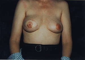 Breast Reconstruction 4b
